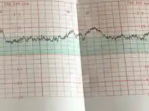 When can you hear the baby's heartbeat by doppler​