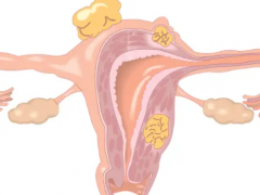 What are the signs of cervical cancer​